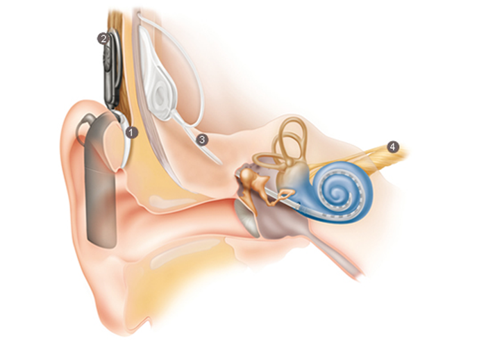 implante coclear2